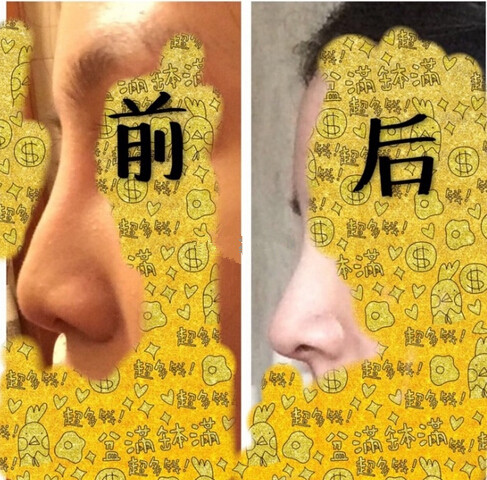 南宁美丽焦点焦俊光做的注射物取出、鼻部手术