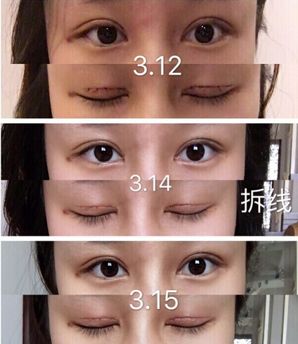 上海九院谢芸医生做的全切双眼皮手术