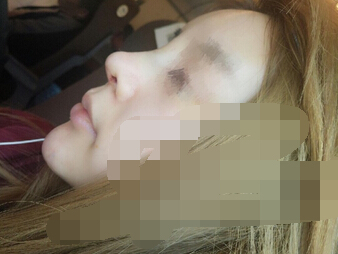武汉美天朱晓浩院长做的鼻部手术手术