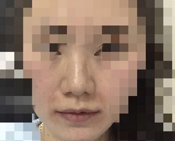 【经验分享】南京康美房志强医生做的鼻部手术手