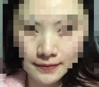 【经验分享】南京康美房志强医生做的鼻部手术手