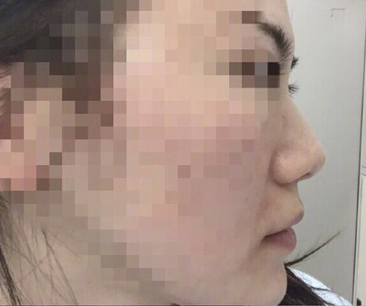 【经验分享】南京康美房志强医生做的鼻部手术手