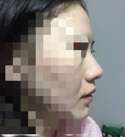 【经验分享】南京康美房志强医生做的鼻部手术手