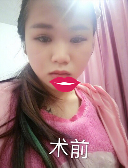 宁波咖禾付德刚主任做的鼻部手术整形手术