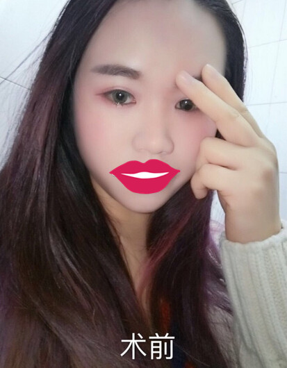 宁波咖禾付德刚主任做的鼻部手术整形手术