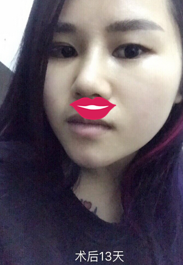 宁波咖禾付德刚主任做的鼻部手术整形手术