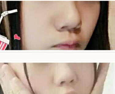 成都娇点李竟医生2万5做的鼻部手术