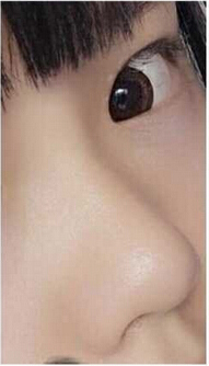 成都娇点李竟医生2万5做的鼻部手术