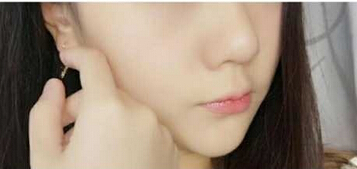 成都娇点李竟医生2万5做的鼻部手术