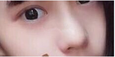 成都娇点李竟医生2万5做的鼻部手术