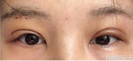 深圳非凡医疗美容医院杨主任做的双眼皮手术