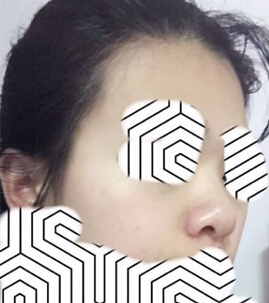 长沙湘雅附二王先成医生做的鼻部手术