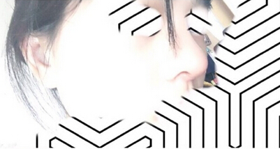 长沙湘雅附二王先成医生做的鼻部手术