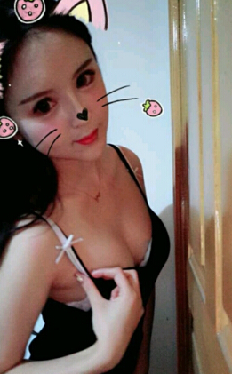 重庆军美整形余成坤做自体脂肪隆胸手术果