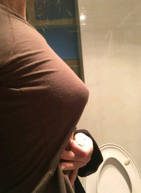 军美整形医院余成坤做的隆胸手术果