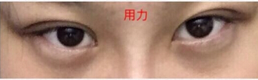 石家庄巍名仕何静医生做的隆鼻垫鼻尖果
