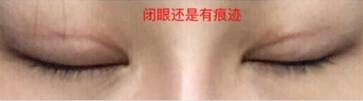 石家庄巍名仕何静医生做的隆鼻垫鼻尖果