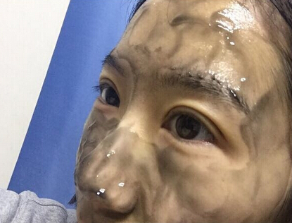 陆新医生做的全切双眼皮,价格不到3850