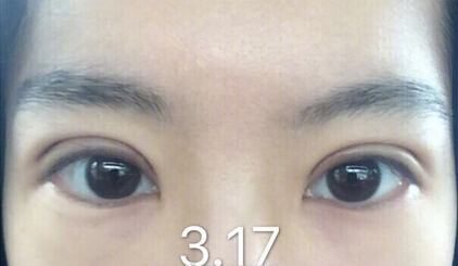 陆新医生做的全切双眼皮,价格不到3850