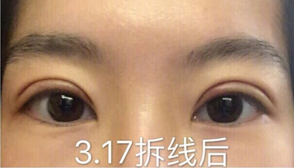 陆新医生做的全切双眼皮,价格不到3850