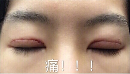 陆新医生做的全切双眼皮,价格不到3850