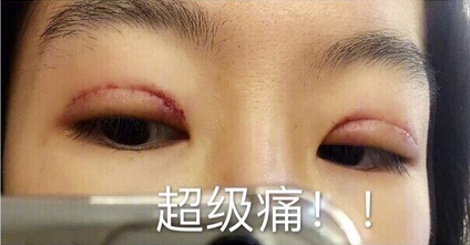 陆新医生做的全切双眼皮,价格不到3850