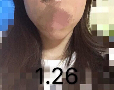 上海九院,谢芸双眼皮,黄如林注射瘦脸反馈一例