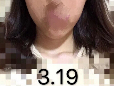 上海九院,谢芸双眼皮,黄如林注射瘦脸反馈一例