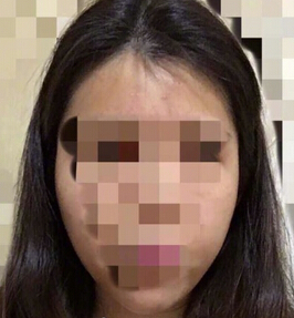 上海九院,谢芸双眼皮,黄如林注射瘦脸反馈一例