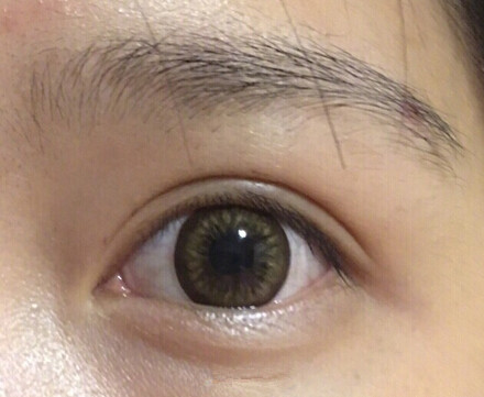 上海九院,谢芸双眼皮,黄如林注射瘦脸反馈一例