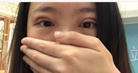 深圳美莱医院陈磊医生做的全切双眼皮果