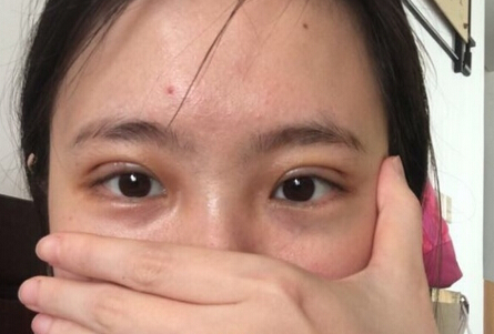 深圳美莱医院陈磊医生做的全切双眼皮果