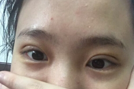 深圳美莱医院陈磊医生做的全切双眼皮果