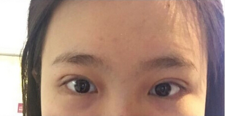 深圳美莱医院陈磊医生做的全切双眼皮果