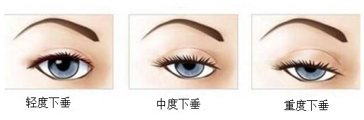 我的眼睛是不是睑下垂?到底要不要做提肌?