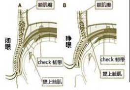 我的眼睛是不是睑下垂?到底要不要做提肌?
