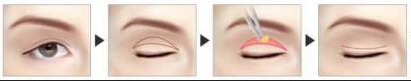 我的眼睛是不是睑下垂?到底要不要做提肌?