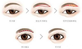 我的眼睛是不是睑下垂?到底要不要做提肌?