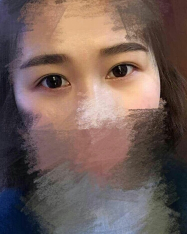 成都景华医学美容江涛医生做的眼部手术果