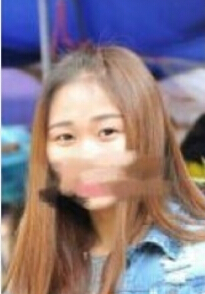 成都景华医学美容江涛医生做的眼部手术果