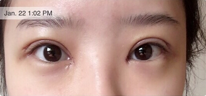 【案例分享】武汉协和医院杨杰做的双眼皮果