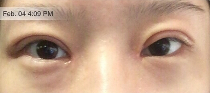 【案例分享】武汉协和医院杨杰做的双眼皮果