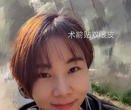 武汉天佑医院整形美容科做双眼皮怎么样?