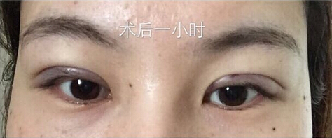 武汉天佑医院整形美容科做双眼皮怎么样?