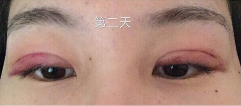 武汉天佑医院整形美容科做双眼皮怎么样?