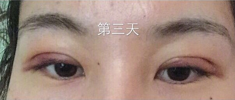 武汉天佑医院整形美容科做双眼皮怎么样?