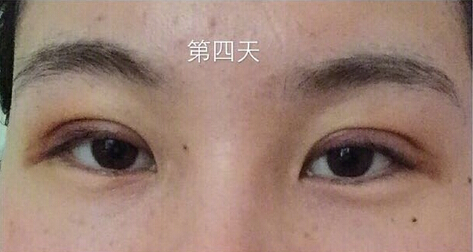 武汉天佑医院整形美容科做双眼皮怎么样?