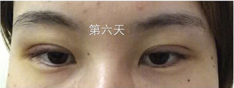 武汉天佑医院整形美容科做双眼皮怎么样?