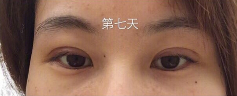 武汉天佑医院整形美容科做双眼皮怎么样?
