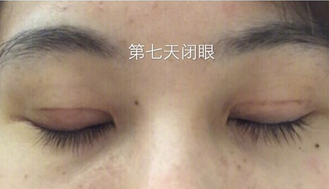 武汉天佑医院整形美容科做双眼皮怎么样?
